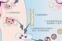 哈尔滨子宫内膜异位症手术费用详解，卡里准备5万完全足够