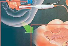 泰国三代试管医院哪家好？泰国三代试管医院的试管成功率有多少