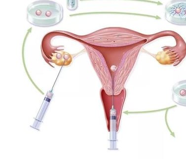 试管婴儿步骤费用介绍：每个步骤收费都一目了然